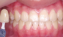 初めてのホワイトニング