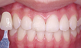 初めてのホワイトニング