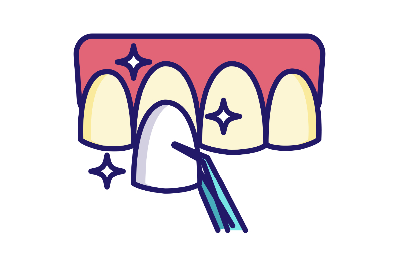 ラミネートべニア