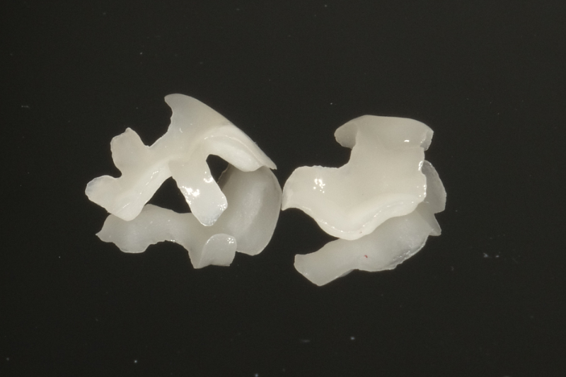 セラミックインレー・アンレー